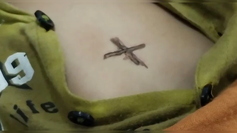 भीलवाड़ा में अंधविश्वास के नाम पर मासूम को गर्म सलाख से दागा, इलाज के दौरान मौत